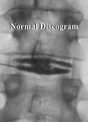 Normal discogram