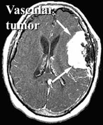 Vascular Tumor