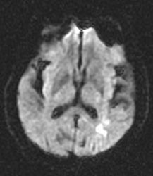 Brain Diffusion