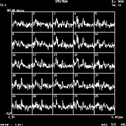 MR Spectroscopy