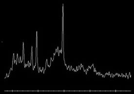 MR Spectroscopy