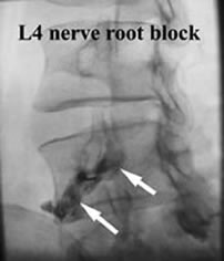 Nerve Block