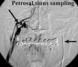 Petrosal Sinus Sampling