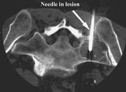 Sacral Biopsy