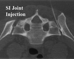 SI and Facet Joint Injection