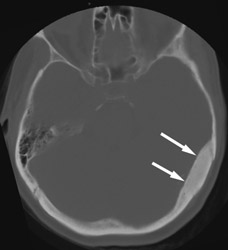 Skull Biopsy