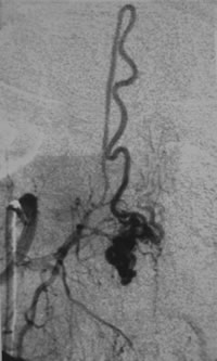 Spinal Angiogram