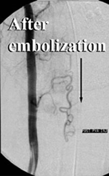 After embolization