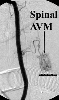 Spinal AVM