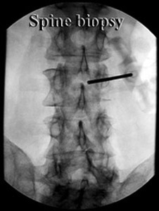 Spine Biopsy