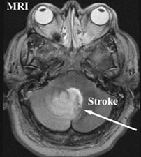 t2 MR of Stroke