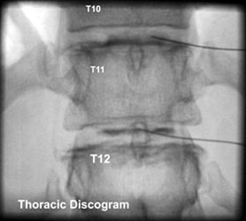 Thoracic Discogram