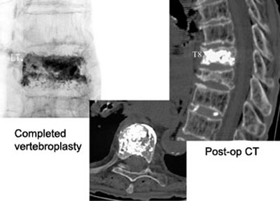 Vertebroplasty