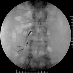 Embolization of Vertical Body