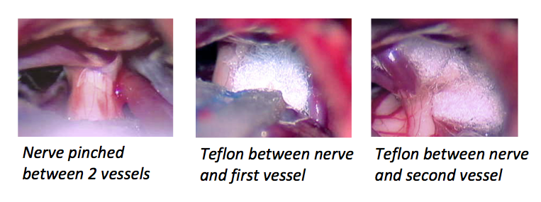 Microvascular Decompression