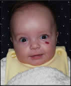 Child with hemangioma