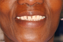 Before Prosthodontic Treatment