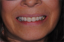 After prosthodontic treatment