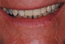 After prosthodontic treatment