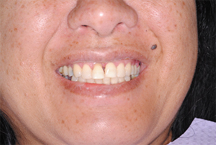 Before prosthodontic treatment