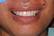 After prosthodontic treatment