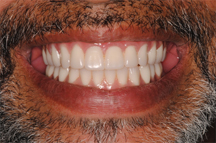 After prosthodontic treatment