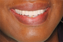 After prosthodontic treatment