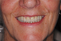 After prosthodontic treatment