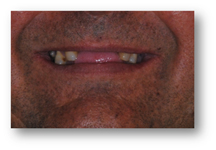 Before prosthodontic treatment