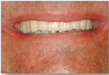 After prosthodontic treatment