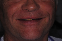 Before prosthodontic treatment